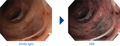 EVIS EXERA III Bronchoscopy